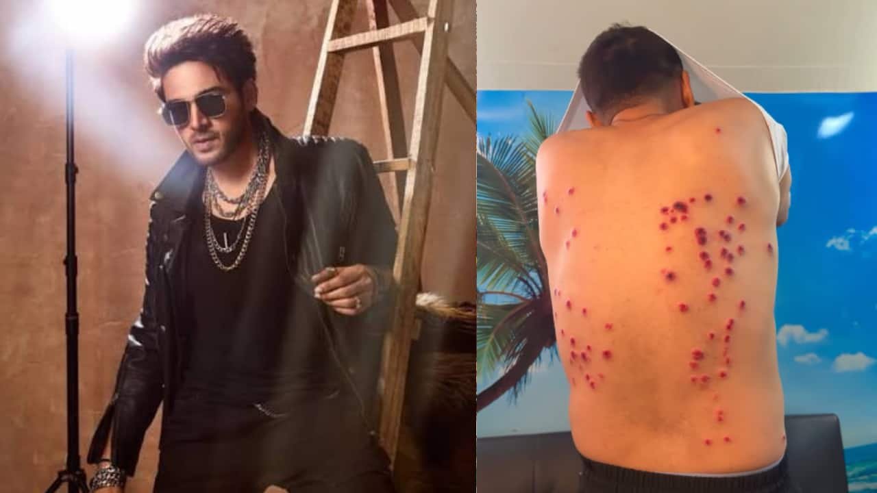 Khatron Ke Khiladi 15: Gaurav Khanna Suffers painful burns by pellet gun during task; 'Can still feel the pain'